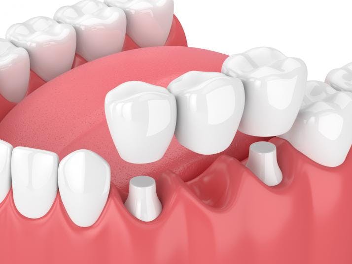 Dental Crowns and Bridges in Gyor | Perident Dentistry