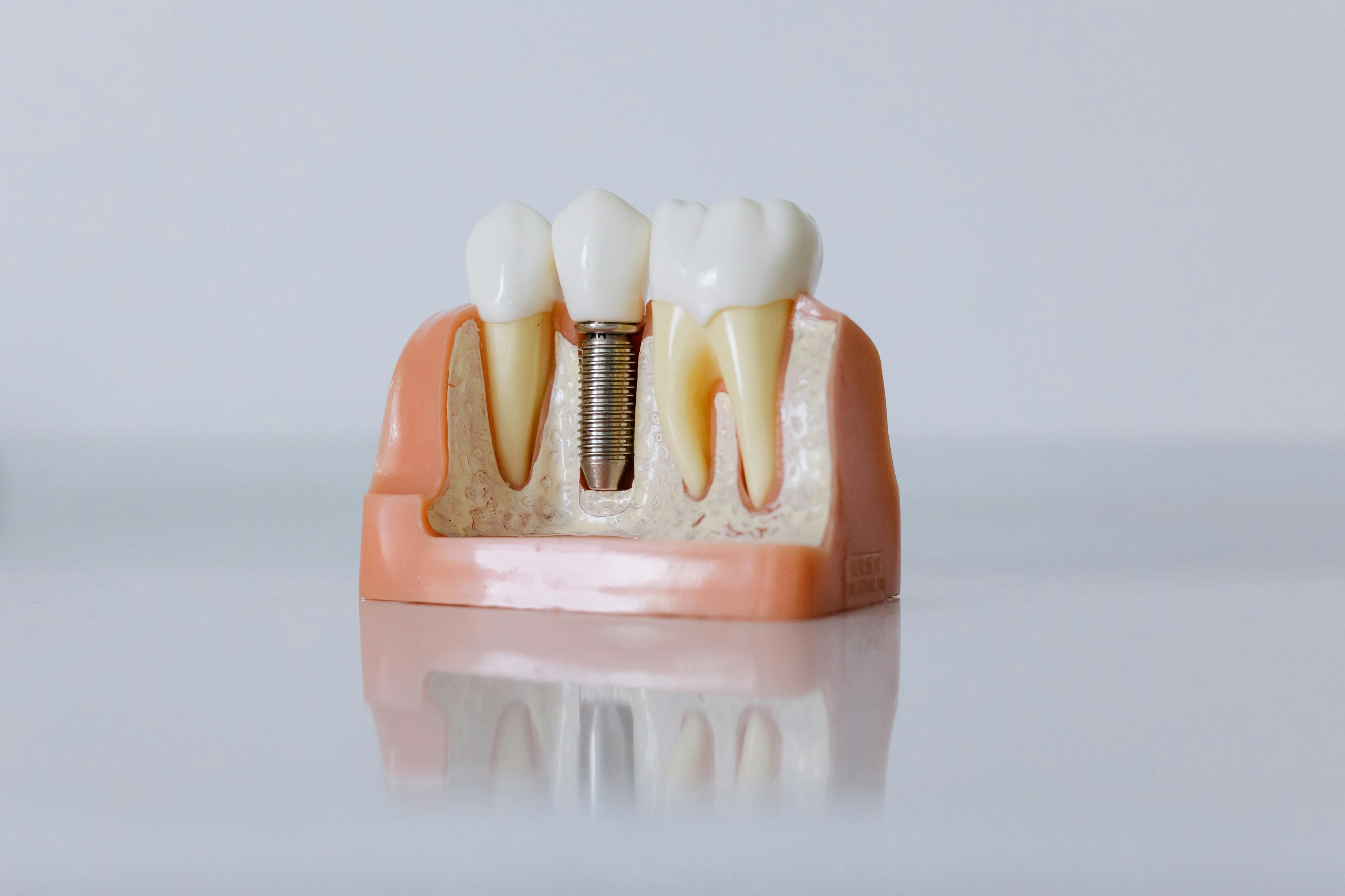 Zahnimplantate in Györ | Zahnarztpraxis Perident